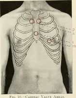 An illustration from Diseases of the heart and arterial system : designed to be a practical presentation of the subject for the use of students and practitioners of medicine / by Robert H. Babcock ... with three coloured plates and one hundred and thirty-nine illustrations. (1903)
