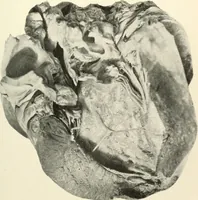 An illustration from Diseases of the heart and arterial system : designed to be a practical presentation of the subject for the use of students and practitioners of medicine / by Robert H. Babcock ... with three coloured plates and one hundred and thirty-nine illustrations. (1903)