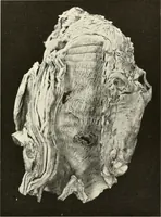 An illustration from Diseases of the heart and arterial system : designed to be a practical presentation of the subject for the use of students and practitioners of medicine / by Robert H. Babcock ... with three coloured plates and one hundred and thirty-nine illustrations. (1903)