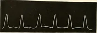 An illustration from Diseases of the heart and arterial system : designed to be a practical presentation of the subject for the use of students and practitioners of medicine / by Robert H. Babcock ... with three coloured plates and one hundred and thirty-nine illustrations. (1903)