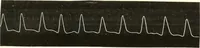 An illustration from Diseases of the heart and arterial system : designed to be a practical presentation of the subject for the use of students and practitioners of medicine / by Robert H. Babcock ... with three coloured plates and one hundred and thirty-nine illustrations. (1903)