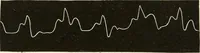 An illustration from Diseases of the heart and arterial system : designed to be a practical presentation of the subject for the use of students and practitioners of medicine / by Robert H. Babcock ... with three coloured plates and one hundred and thirty-nine illustrations. (1903)