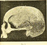 An illustration from Nouvelles recherches de psychiatrie et d'anthropologie criminelle / par Cesare Lombroso. (1892)