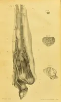 An illustration from Further observations on the variolæ vaccinæ, illustrated with coloured engravings from original drawings / By Robert Ceely. (1842)