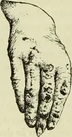 An illustration from Traité pratique et théorique de la lèpre / par Henri Leloir. (1886)