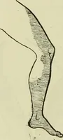An illustration from Traité pratique et théorique de la lèpre / par Henri Leloir. (1886)
