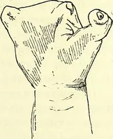 An illustration from Traité pratique et théorique de la lèpre / par Henri Leloir. (1886)