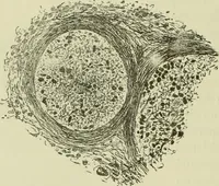 An illustration from Traité pratique et théorique de la lèpre / par Henri Leloir. (1886)