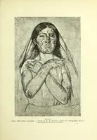 An illustration from Traité pratique et théorique de la lèpre / par Henri Leloir. (1886)