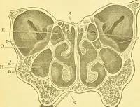 An illustration from Diseases of the nose and throat / by F. de Havilland Hall ... With 2 coloured plates and 59 illustrations. (1894)