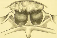 An illustration from Diseases of the nose and throat / by F. de Havilland Hall ... With 2 coloured plates and 59 illustrations. (1894)