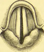 An illustration from Diseases of the nose and throat / by F. de Havilland Hall ... With 2 coloured plates and 59 illustrations. (1894)