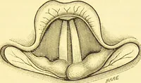 An illustration from Diseases of the nose and throat / by F. de Havilland Hall ... With 2 coloured plates and 59 illustrations. (1894)