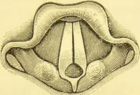 An illustration from Diseases of the nose and throat / by F. de Havilland Hall ... With 2 coloured plates and 59 illustrations. (1894)