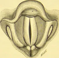 An illustration from Diseases of the nose and throat / by F. de Havilland Hall ... With 2 coloured plates and 59 illustrations. (1894)