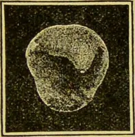Picture 18 of 65 from Diseases of the ear, nose, and throat and their accessory cavities : A condensed text-book / By Seth Scott Bishop. (1897), leaf 101