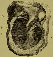 An illustration from Diseases of the ear, nose, and throat and their accessory cavities : A condensed text-book / By Seth Scott Bishop. (1897)