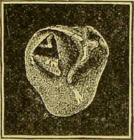 Picture 27 of 65 from Diseases of the ear, nose, and throat and their accessory cavities : A condensed text-book / By Seth Scott Bishop. (1897), leaf 127