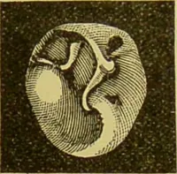 An illustration from Diseases of the ear, nose, and throat and their accessory cavities : A condensed text-book / By Seth Scott Bishop. (1897)