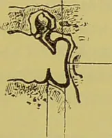 An illustration from Diseases of the ear, nose, and throat and their accessory cavities : A condensed text-book / By Seth Scott Bishop. (1897)