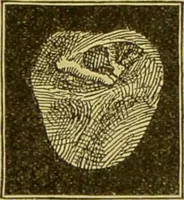 An illustration from Diseases of the ear, nose, and throat and their accessory cavities : A condensed text-book / By Seth Scott Bishop. (1897)