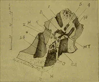 An illustration from Diseases of the ear, nose, and throat and their accessory cavities : A condensed text-book / By Seth Scott Bishop. (1897)