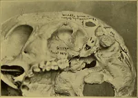 An illustration from Diseases of the ear, nose, and throat and their accessory cavities : A condensed text-book / By Seth Scott Bishop. (1897)