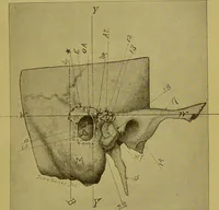 An illustration from Diseases of the ear, nose, and throat and their accessory cavities : A condensed text-book / By Seth Scott Bishop. (1897)