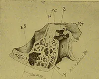 An illustration from Diseases of the ear, nose, and throat and their accessory cavities : A condensed text-book / By Seth Scott Bishop. (1897)