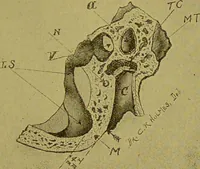 An illustration from Diseases of the ear, nose, and throat and their accessory cavities : A condensed text-book / By Seth Scott Bishop. (1897)