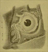 An illustration from Diseases of the ear, nose, and throat and their accessory cavities : A condensed text-book / By Seth Scott Bishop. (1897)