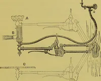 An illustration from Diseases of the ear, nose, and throat and their accessory cavities : A condensed text-book / By Seth Scott Bishop. (1897)