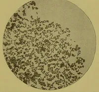 An illustration from Diseases of the ear, nose, and throat and their accessory cavities : A condensed text-book / By Seth Scott Bishop. (1897)