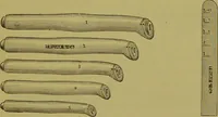 An illustration from Diseases of the ear, nose, and throat and their accessory cavities : A condensed text-book / By Seth Scott Bishop. (1897)