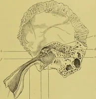 An illustration from Diseases of the ear, nose, and throat and their accessory cavities : A condensed text-book / By Seth Scott Bishop. (1897)