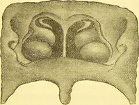 An illustration from Laryngoscopy and rhinoscopy and the diagnosis and treatment of the diseases of the throat and nose / by Prosser James, M.D. (1888)