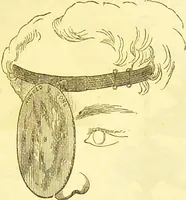 An illustration from Laryngoscopy and rhinoscopy and the diagnosis and treatment of the diseases of the throat and nose / by Prosser James, M.D. (1888)