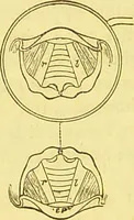 An illustration from Laryngoscopy and rhinoscopy and the diagnosis and treatment of the diseases of the throat and nose / by Prosser James, M.D. (1888)