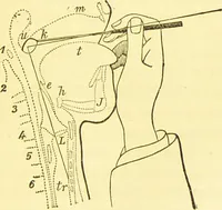 Picture 24 of 42 from Laryngoscopy and rhinoscopy and the diagnosis and treatment of the diseases of the throat and nose / by Prosser James, M.D. (1888), leaf 99