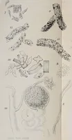 An illustration from Lectures on the diseases of the kidney, generally known as "Brights' disease", and dropsy / by S. J. Goodfellow. (1861)