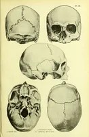 An illustration from Norrønaskaller : crania antiqua in parte orientali Norvegiae meridionalis inventa / en studie fra Universitetets Anatomiske Institut og dette tilegnet af Justus Barth ... ; udgivet ved G.A. Guldberg. (1896)