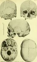 An illustration from Norrønaskaller : crania antiqua in parte orientali Norvegiae meridionalis inventa / en studie fra Universitetets Anatomiske Institut og dette tilegnet af Justus Barth ... ; udgivet ved G.A. Guldberg. (1896)