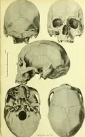An illustration from Norrønaskaller : crania antiqua in parte orientali Norvegiae meridionalis inventa / en studie fra Universitetets Anatomiske Institut og dette tilegnet af Justus Barth ... ; udgivet ved G.A. Guldberg. (1896)