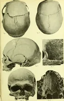 An illustration from Norrønaskaller : crania antiqua in parte orientali Norvegiae meridionalis inventa / en studie fra Universitetets Anatomiske Institut og dette tilegnet af Justus Barth ... ; udgivet ved G.A. Guldberg. (1896)