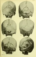 An illustration from Norrønaskaller : crania antiqua in parte orientali Norvegiae meridionalis inventa / en studie fra Universitetets Anatomiske Institut og dette tilegnet af Justus Barth ... ; udgivet ved G.A. Guldberg. (1896)