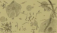 An illustration from Clinical diagnosis : the bacteriological, chemical, and microscopical evidence of disease / By Dr. Rudolf v. Jaksch, ... Translated from the third German edition and enlarged by James Cagney, ... With numerous illustrations (partly in colours). (1893)