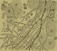 An illustration from Clinical diagnosis : the bacteriological, chemical, and microscopical evidence of disease / By Dr. Rudolf v. Jaksch, ... Translated from the third German edition and enlarged by James Cagney, ... With numerous illustrations (partly in colours). (1893)