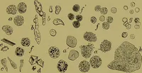 An illustration from Clinical diagnosis : the bacteriological, chemical, and microscopical evidence of disease / By Dr. Rudolf v. Jaksch, ... Translated from the third German edition and enlarged by James Cagney, ... With numerous illustrations (partly in colours). (1893)