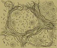An illustration from Clinical diagnosis : the bacteriological, chemical, and microscopical evidence of disease / By Dr. Rudolf v. Jaksch, ... Translated from the third German edition and enlarged by James Cagney, ... With numerous illustrations (partly in colours). (1893)