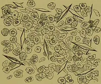 An illustration from Clinical diagnosis : the bacteriological, chemical, and microscopical evidence of disease / By Dr. Rudolf v. Jaksch, ... Translated from the third German edition and enlarged by James Cagney, ... With numerous illustrations (partly in colours). (1893)